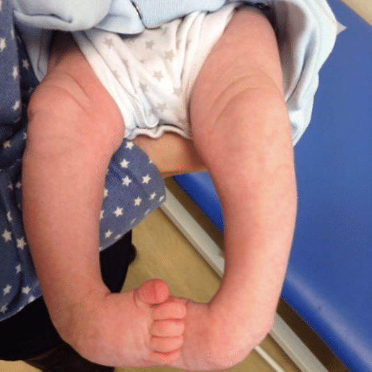 baby with talipes before treatment